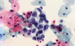 宫颈细胞液基薄层细胞制片技术 协和星原计划  子宫颈病变不要慌，一文教您读懂宫颈液基细胞学检查报告